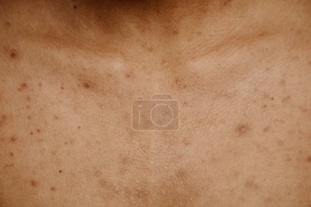 Photo for Macro shot of tan skin with acne scar spots and texture, copy space - Royalty Free Image