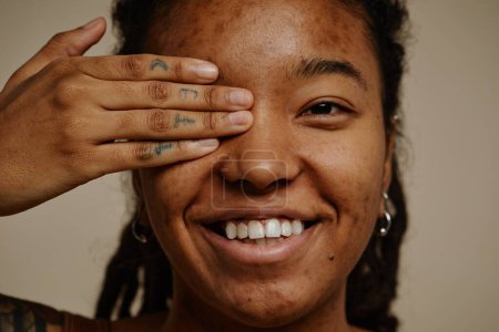 Téléchargez les photos : Gros plan portrait de jeune femme ethnique souriant franchement avec un oeil fermé, cicatrices d'acné texture de peau - en image libre de droit