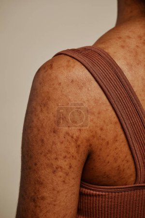 Téléchargez les photos : Plan détaillé du corps féminin mettant l'accent sur la texture de la peau et les cicatrices d'acné sur le dos et les épaules - en image libre de droit