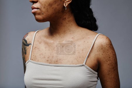 Téléchargez les photos : Détail rapproché de la jeune femme noire avec une texture de peau réelle et des cicatrices d'acné, espace de copie - en image libre de droit