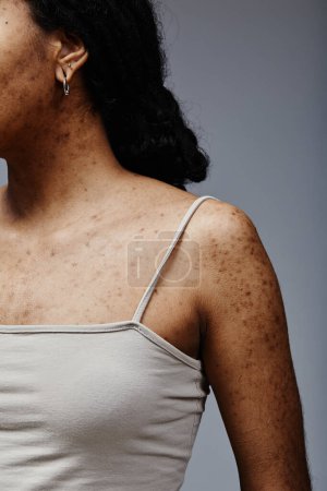 Foto de Detalle vertical de la imagen de mujer joven negra con pecas de textura de piel real y cicatrices de acné, mínimo - Imagen libre de derechos