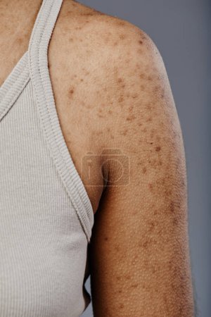 Foto de Detalle de primer plano imagen de mujer joven negra con textura de piel real y cicatrices de acné en hombros y brazos - Imagen libre de derechos