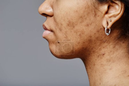Téléchargez les photos : Vue latérale rapprochée de la jeune femme noire avec une texture de peau réelle et des cicatrices d'acné sur le visage et le cou, espace de copie - en image libre de droit