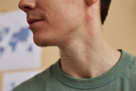 Foto de Vista lateral de primer plano del hombre joven con erupción cutánea o manchas de psoriasis en el cuello, espacio para copiar - Imagen libre de derechos