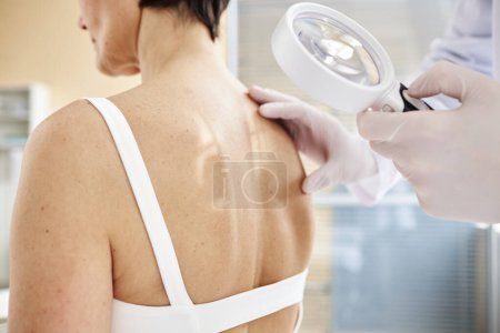 Foto de Primer plano del médico sosteniendo lupa mientras examina la espalda de la paciente femenina en la clínica de dermatología, espacio para copiar - Imagen libre de derechos