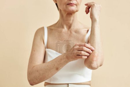 Téléchargez les photos : Gros plan minimal de la femme mature avec une tache de psoriasis sur les bras, concepts d'état de la peau - en image libre de droit