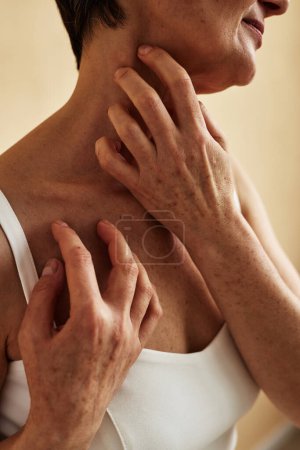 Foto de Primer plano de la mujer irreconocible rascarse el cuello que sufre de picazón y alergia, espacio de copia - Imagen libre de derechos