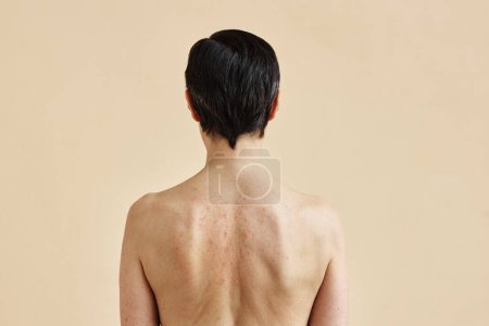 Téléchargez les photos : Vue arrière minimale de la femme adulte avec des taches éruptives sur le dos nu debout sur fond beige, espace de copie - en image libre de droit