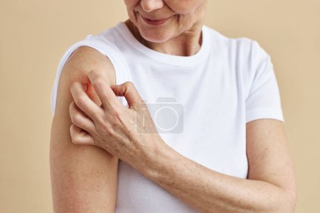Minimal closeup of unrecognizable woman scratching red spot on shoulder, copy space