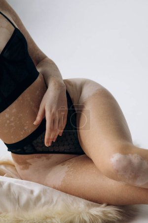 Schöne Mädchen mit Problemhaut. Die Behandlung von Vitiligo. Brünette in Dessous mit Flecken auf ihrem Körper