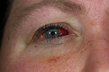 Photo for Closeup of an injured bloodshot eye - Royalty Free Image