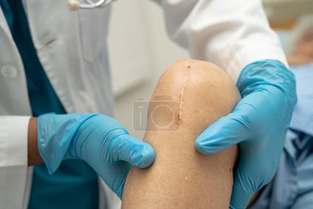 Foto de Doctor check Asian senior or elderly old lady woman patient scars surgical total knee joint replacement Suture wound surgery arthroplasty on bed in nursing hospital ward, healthy strong medical concept. - Imagen libre de derechos