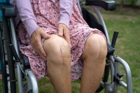 Foto de Asiática senior o anciana anciana mujer paciente mostrar sus cicatrices cirugía total rodilla reemplazo articular sutura herida cirugía artroplastia en cama en enfermería hospital sala, saludable fuerte concepto médico. - Imagen libre de derechos
