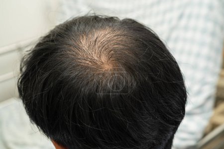 Téléchargez les photos : Bald in the middle head and begin no loss hair glabrous of mature Asian business smart active office man. - en image libre de droit