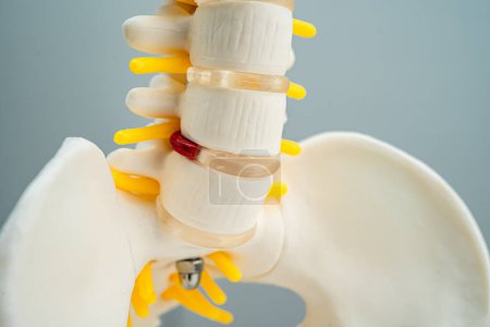 Foto de La columna lumbar desplazó el fragmento de disco herniado, el nervio espinal y el hueso. Modelo de tratamiento médico en el departamento ortopédico. - Imagen libre de derechos