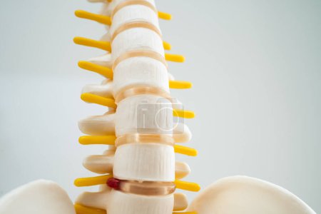 Foto de La columna lumbar desplazó el fragmento de disco herniado, el nervio espinal y el hueso. Modelo de tratamiento médico en el departamento ortopédico. - Imagen libre de derechos
