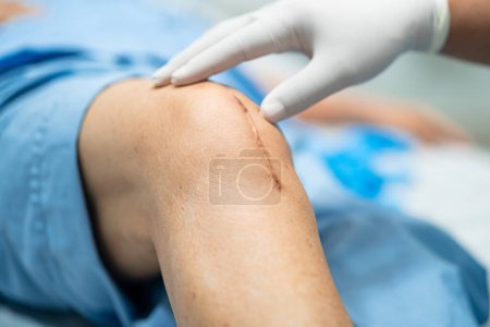 Photo for Asian elderly woman patient show her scars surgical total knee joint replacement Suture wound surgery arthroplasty on bed in hospital, healthy strong medical concept. - Royalty Free Image