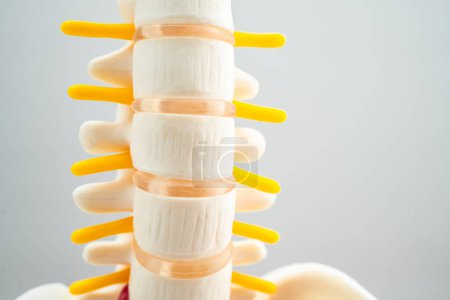 Photo for Lumbar spine displaced herniated disc fragment, spinal nerve and bone. Model for treatment medical in the orthopedic department. - Royalty Free Image