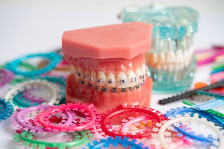 Kieferorthopädische Ligaturen Ringe und Bänder, elastische Gummibänder an kieferorthopädischen Zahnspangen, Modell für Zahnarztstudien über Zahnmedizin.