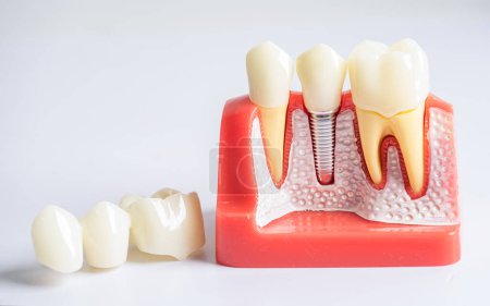 Implante dental, raíces dentales artificiales en la mandíbula, conducto radicular del tratamiento dental, enfermedad de las encías, modelo de dientes para dentista que estudia odontología.