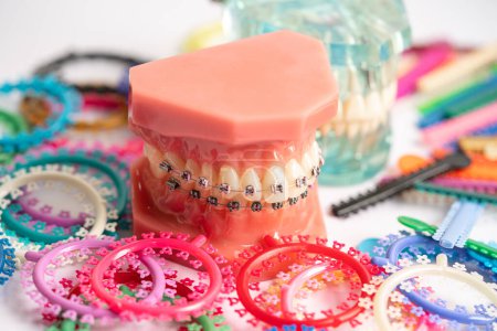 Kieferorthopädische Ligaturen Ringe und Bänder, elastische Gummibänder an kieferorthopädischen Zahnspangen, Modell für Zahnarztstudien über Zahnmedizin.