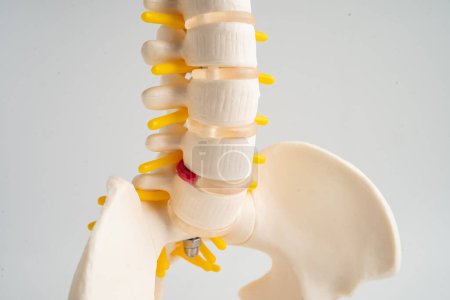 La columna lumbar desplazó el fragmento de disco herniado, el nervio espinal y el hueso. Modelo de tratamiento médico en el departamento ortopédico.