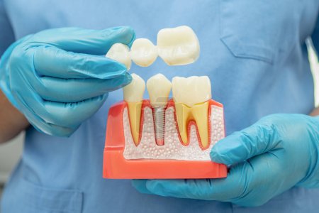 Zahnimplantat, künstliche Zahnwurzeln in den Kiefer, Wurzelkanal der Zahnbehandlung, Zahnfleischerkrankungen, Zahnmodell für Zahnärzte, die Zahnmedizin studieren.