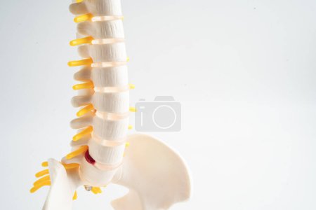 La columna lumbar desplazó el fragmento de disco herniado, el nervio espinal y el hueso. Modelo con espacio de copia para tratamiento médico en el departamento ortopédico.