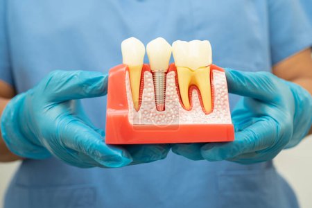 Implante dental, raíces dentales artificiales en la mandíbula, conducto radicular del tratamiento dental, enfermedad de las encías, modelo de dientes para dentista que estudia odontología.
