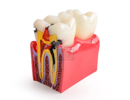 Caries dental, implante dental, raíces dentales artificiales en la mandíbula, conducto radicular, enfermedad de las encías, modelo de dientes aislados sobre fondo blanco con camino de recorte.