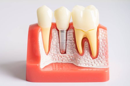 Dental implant, artificial tooth roots into jaw, root canal of dental treatment, gum disease, teeth model for dentist studying about dentistry.