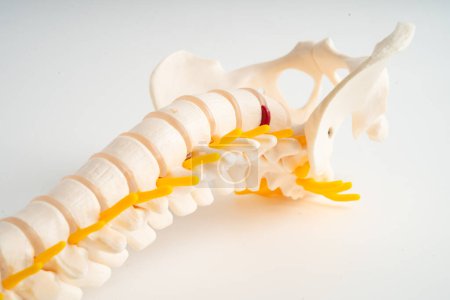 Lendenwirbelsäule verdrängte Bandscheibenvorfall, Spinalnerv und Knochen. Modell für die Behandlung in der orthopädischen Abteilung.