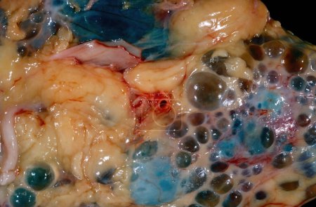 Foto de Primer plano de un espécimen bruto que muestra la superficie de un riñón humano en un caso de enfermedad renal poliquística autosómica dominante (ADPKD). La superficie está llena de quistes grandes. La ADPKD es causada por mutaciones en los genes de la PKD que producen un prote anormal específico - Imagen libre de derechos