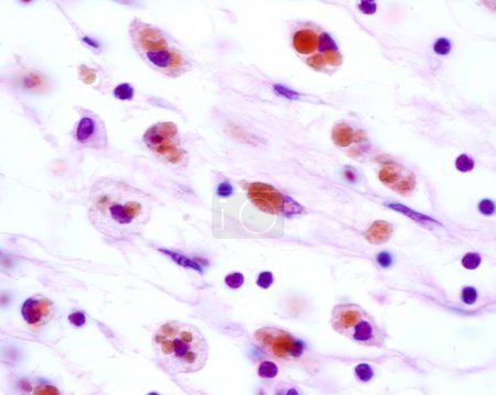Téléchargez les photos : Macrophages montrant de grandes inclusions brunes provenant de la phagocytose des globules rouges après une hémorragie - en image libre de droit