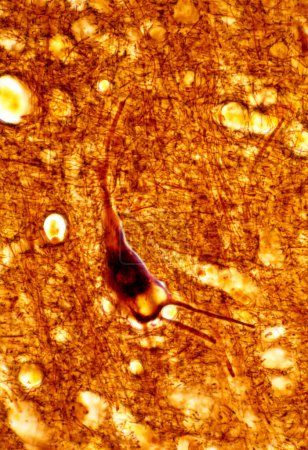 Téléchargez les photos : Light micrograph of a human cerebral cortex of a senile cerebrum, stained with a silver method, showing a large deposit of lipofuscin in a pyramidal neuron. - en image libre de droit