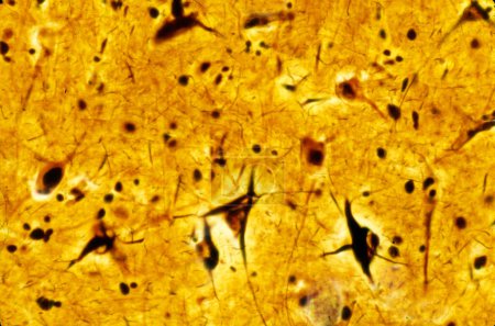 Téléchargez les photos : Micrographie photonique d'un cortex cérébral humain montrant des enchevêtrements neurofibrillaires dans plusieurs neurones pyramidaux. Les enchevêtrements neurofibrillaires (TVN) sont une lésion neuropathologique caractéristique de la maladie d'Alzheimer (MA). Ils sont composés d'un très-phosphore - en image libre de droit