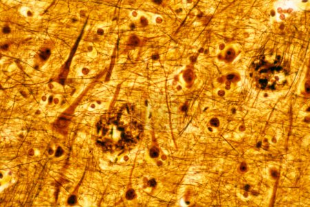 Téléchargez les photos : Microscope photonique d'un cortex cérébral humain montrant deux plaques séniles, colorées avec une méthode argent. Ce sont des dépôts extracellulaires de bêta amyloïde qui apparaissent en grand nombre dans la maladie d'Alzheimer. - en image libre de droit