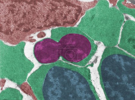 Farbige Transmissionselektronenmikroskopie (TEM) von Normoblasten, einer kernhaltigen (blauen) Vorstufe roter Blutkörperchen im Prozess der Austreibung oder Extrusion des Zellkerns (Magenta). Am Ende dieses Prozesses bleibt eine anukleierte Retikulozyte übrig.