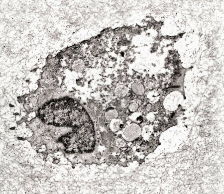 Elektronenmikroskopische Aufnahme eines sterbenden Chondrozyten aus der Verkalkungszone der Wachstumsplatte. Die Plasmamembran ist kaputt und die zytoplasmatischen Organellen werden zerstört.