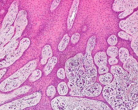 Foto de Micrografía ligera de una encía humana que muestra las crestas retes largas y complejas existentes en la base del epitelio escamoso estratificado no queratinizado. El tejido conectivo debajo del epitelio muestra infiltrados inflamatorios crónicos (gingivitis)). - Imagen libre de derechos