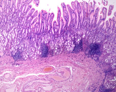 Photo for Mucosa of the stomach in the region of the pyloric antrum showing its typical features: great depth of the gastric crypts and presence of pyloric glands. There are chronic inflammatory infiltrates and presence of lymphoid follicles in the lamina prop - Royalty Free Image