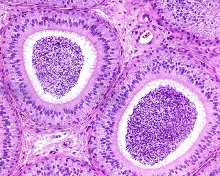 Epididymal ducts lined by pseudostratified epithelium with tall columnar principal cells showing stereocilia and basal cells. The function of epididymis is the storage, maturation and transport of sperm cells. During their transit in the epididymis, 