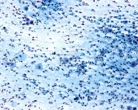 Photo for Vaginal smear stained with Papanicolau method. The visible cells are all normal squamous superficial cells with polygonal shape, pyknotic nuclei and bluish or redish cytoplasm, and some parabasal cells. The abundance of neutrophil leukocytes suggests - Royalty Free Image