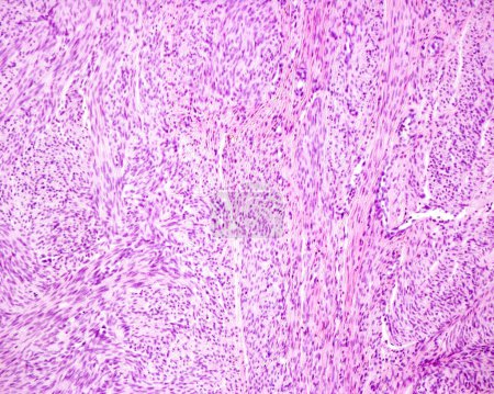Microscopio de luz de un fibroma uterino o leiomioma, un tumor benigno común de las fibras musculares lisas del miometrio, que muestra el patrón vertiginoso característico de los haces musculares lisos. 