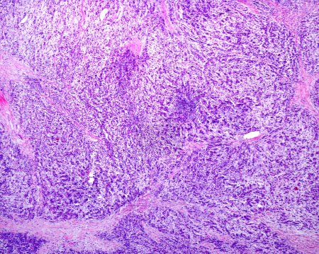 Pleomorphic adenoma is a common benign salivary gland tumour characterised by a proliferation of epithelial (ductal) and myoepithelial cells with a components with a variable background stroma. Morphological diversity is the most characteristic featu
