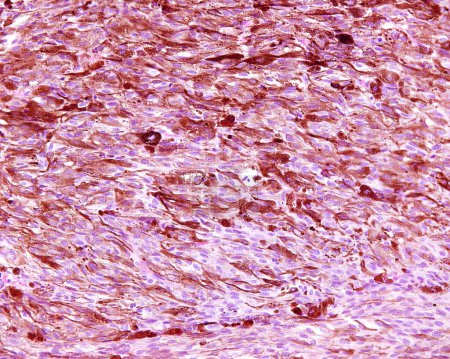 Téléchargez les photos : Microscope photonique d'un mélanome, le plus mortel de tous les cancers de la peau et est fortement lié aux mutations acquises causées par l'exposition aux rayons UV en plein soleil. La tumeur est formée par des brins de cellules malignes en forme de fuseau avec amo variable - en image libre de droit