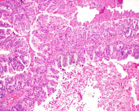 Serous ovarian cancer is the most common type of epithelial ovarian cancer. High grade serous carcinoma accounts for 75% of all epithelial ovarian cancer. Histologically, the pattern is heterogeneous with papillary or solid growth patterns. The tumou