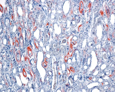 Amyloidose wird durch eine abnorme Faltung normal löslicher Proteine verursacht, die zu Proteinklumpen führt, die als Amyloid-Ablagerungen bezeichnet werden und mit dem roten Kongo-Fleck nachgewiesen werden können. Leichte Mikrographie der Amyloidose in einem menschlichen Nierenmark mit Amyloid st