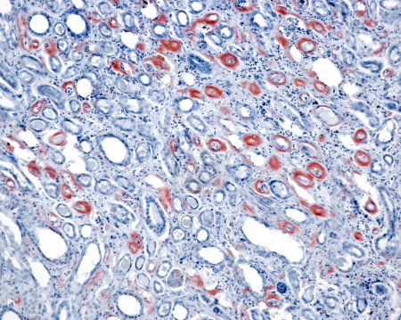Amyloidose wird durch eine abnorme Faltung normal löslicher Proteine verursacht, die zu Proteinklumpen führt, die als Amyloid-Ablagerungen bezeichnet werden und mit dem roten Kongo-Fleck nachgewiesen werden können. Leichte Mikrographie der Amyloidose in einem menschlichen Nierenmark mit Amyloid st