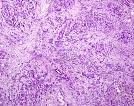 Foto de Micrografía ligera que muestra cuerdas irregulares y nidos de células invasivas de carcinoma ductal que invaden el estroma mamario. - Imagen libre de derechos